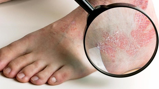 bai-viet/dau-hieu-va-cach-dieu-tri-khi-bi-nuoc-an-chan-hieu-qua-66991.html