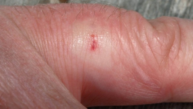 bai-viet/bi-ong-dot-nguy-hiem-khong-lam-gi-khi-bi-ong-dot.html