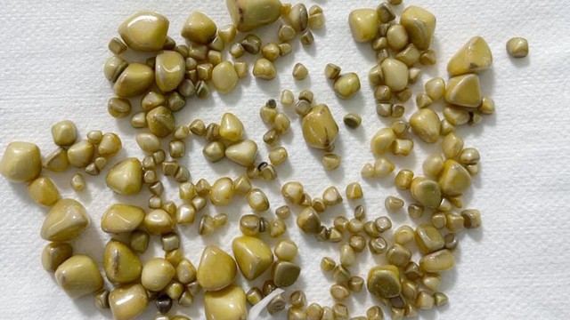 bai-viet/bi-soi-mat-la-benh-gi-cac-thong-tin-lien-quan-den-soi-mat-54890.html