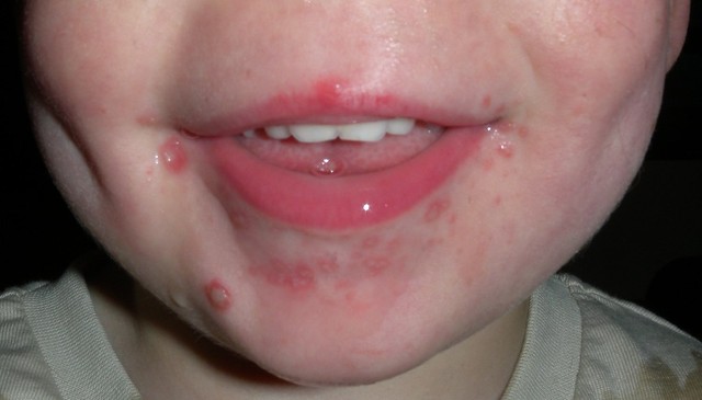 bai-viet/bi-tay-chan-mieng-boi-acyclovir-co-hieu-qua-cho-tre-nho.html