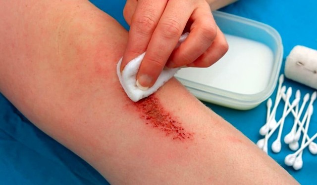 bai-viet/bi-tray-xuoc-da-nen-boi-gi-de-khong-de-lai-seo-57876.html