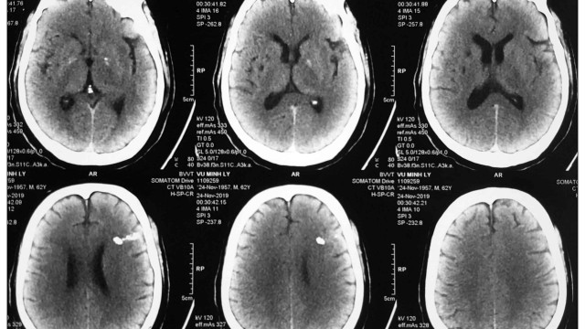 bai-viet/tu-mau-nao-co-nguy-hiem-khong-can-lam-gi-khi-co-dau-hieu-tu-mau-nao.html