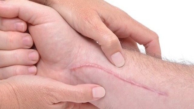 bai-viet/bi-vet-thuong-kieng-an-gi-de-khong-bi-seo-top-4-thuc-pham-can-tranh-khi-bi-thuong.html