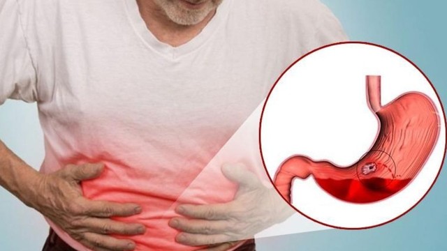 bai-viet/bien-chung-cua-xuat-huyet-da-day-va-nhung-dieu-can-biet.html