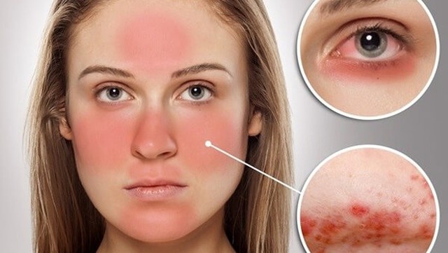 bai-viet/bien-chung-nguy-hiem-lupus-ban-do-bien-chung-huyet-hoc-59087.html