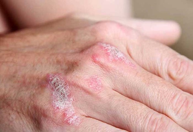 bai-viet/bieu-hien-cua-benh-vay-nen-khong-phai-ai-cung-biet-33340.html