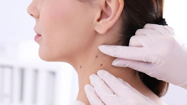 bai-viet/bieu-hien-cua-not-ruoi-khong-dien-hinh-nhu-the-nao.html