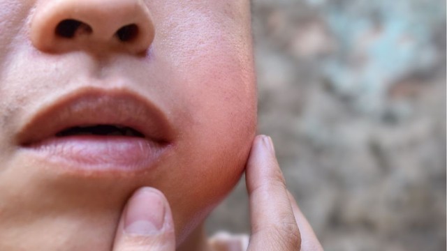 bai-viet/bieu-hien-quai-bi-la-gi-cach-phong-va-tri-benh-ra-sao.html