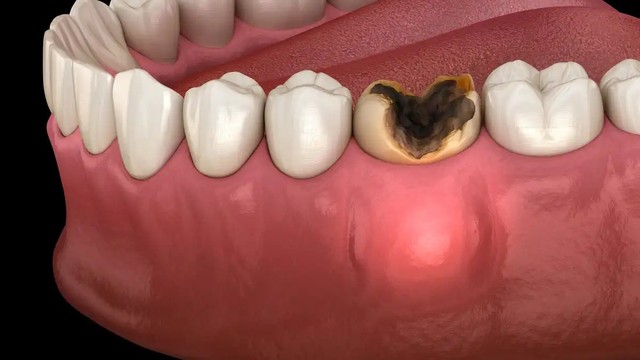 bai-viet/bieu-hien-rang-sau-vao-tuy-la-gi-phuong-phap-dieu-tri-rang-sau-vao-tuy.html