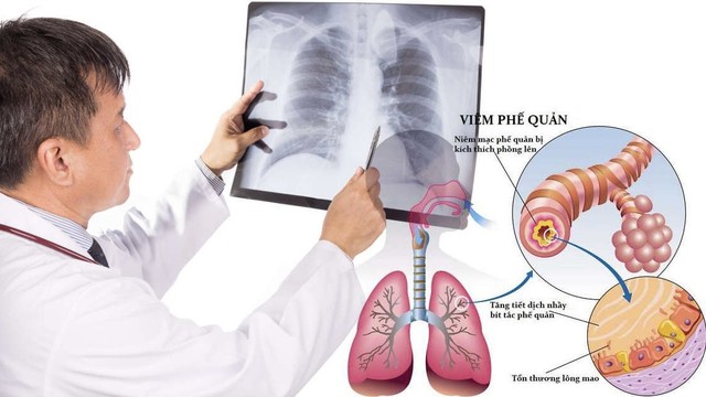 bai-viet/bieu-hien-viem-phe-quan-nhan-dien-som-de-dieu-tri-kip-thoi.html