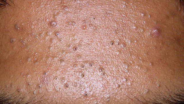 bai-viet/bit-tac-lo-chan-long-nguyen-nhan-va-cach-xu-ly.html