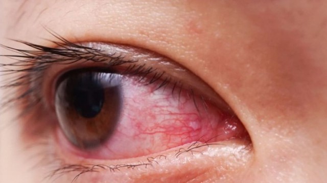 bai-viet/bo-tui-4-cach-tri-dau-mat-do-dan-gian-an-toan-hieu-qua-ngay-tai-nha.html