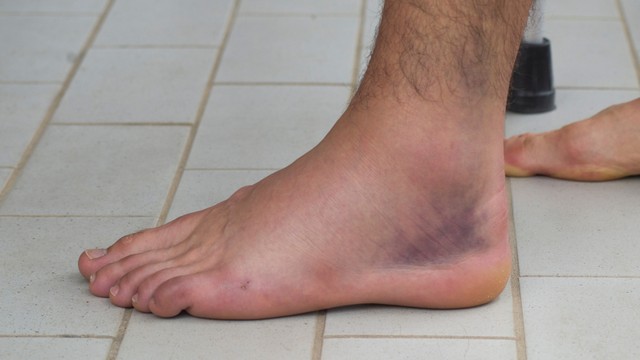 benh/bong-gan-co-chan.html