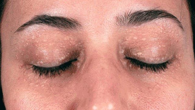 bai-viet/bong-mat-xuat-hien-mun-thit-phai-lam-sao-63105.html