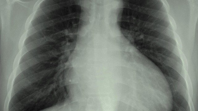 bai-viet/the-nao-la-bong-tim-to-tren-x-quang-nguyen-nhan-va-bien-phap-cai-thien.html