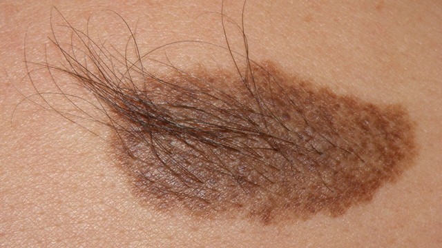 bai-viet/bot-becker-nguyen-nhan-bieu-hien-va-phuong-phap-dieu-tri-hieu-qua.html