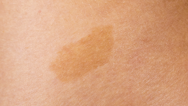 bai-viet/bot-ca-phe-sua-la-gi-nguyen-nhan-va-cach-dieu-tri-bot-ca-phe-sua.html