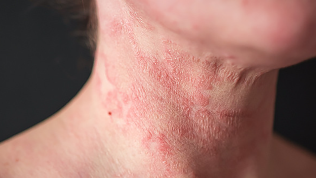 bai-viet/tim-hieu-ve-bot-multidex-deroyal-ho-tro-dieu-tri-nhiem-trung-viem-loet-da.html