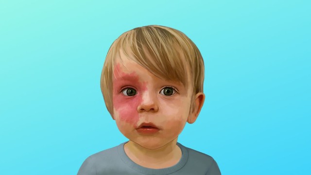 bai-viet/nhung-dieu-can-biet-ve-anh-huong-cua-bot-ruou-vang-va-cach-dieu-tri.html