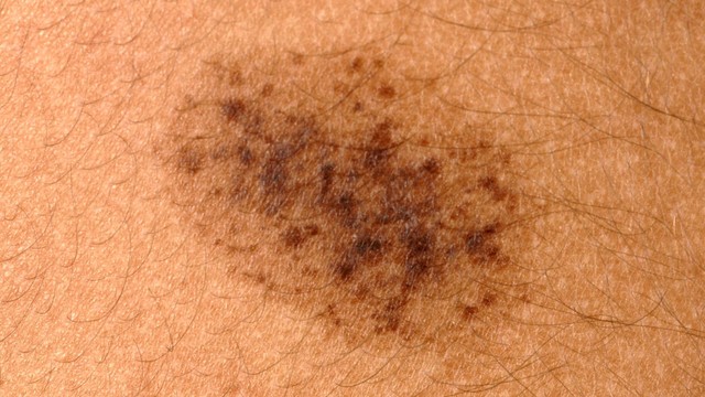 bai-viet/bot-spilus-nguyen-nhan-muc-do-nguy-hiem-va-phuong-phap-dieu-tri.html