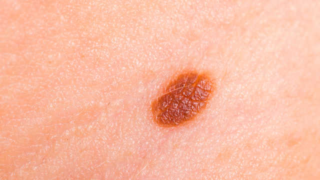 bai-viet/bot-sui-thuong-bi-nguyen-nhan-va-phuong-phap-dieu-tri.html