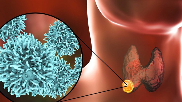 bai-viet/buou-co-dang-keo-la-gi-trieu-chung-va-dieu-tri-buou-co-dang-keo-57363.html