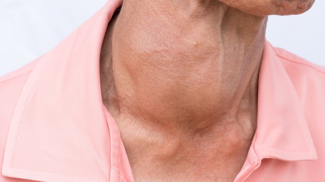 benh/buou-giap-da-nhan.html