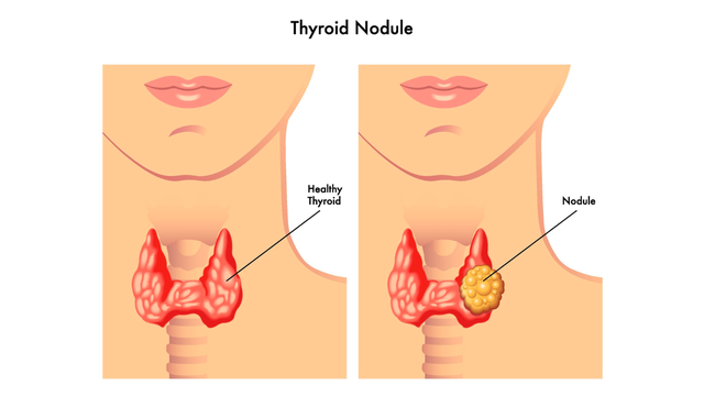 benh/buou-giap-nhan-1.html