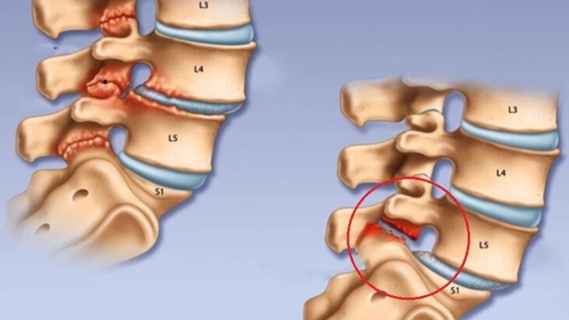 bai-viet/cac-bai-tap-vat-ly-tri-lieu-truot-dot-song-hieu-qua-cao.html