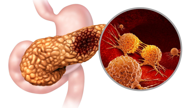 bai-viet/cac-benh-thuong-gap-o-tuy-va-phuong-phap-dieu-tri-phong-ngua-hieu-qua.html