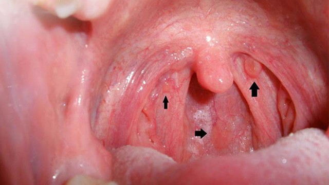 bai-viet/cac-benh-ve-hong-thuong-gap-va-cach-dieu-tri.html