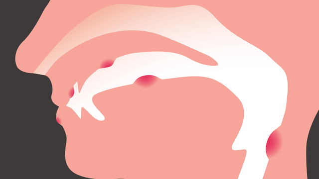 bai-viet/cac-bien-phap-phong-ngua-ung-thu-khoang-mieng-can-biet.html