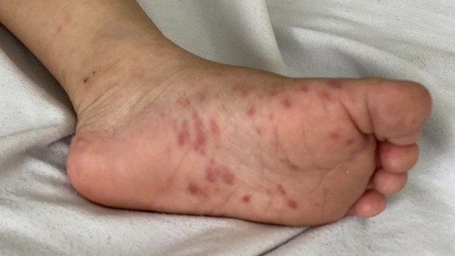 bai-viet/cach-phong-benh-tay-chan-mieng-o-truong-mam-non-ma-phu-huynh-nen-biet.html