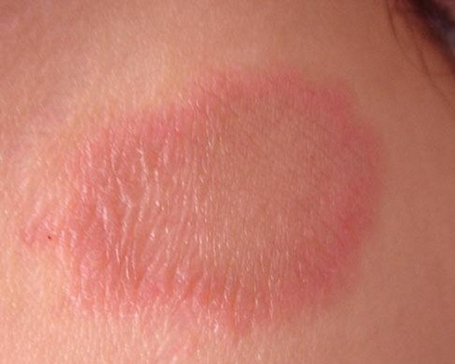 bai-viet/cac-cach-phong-chong-benh-vay-nen-hieu-qua-nhat-35740.html