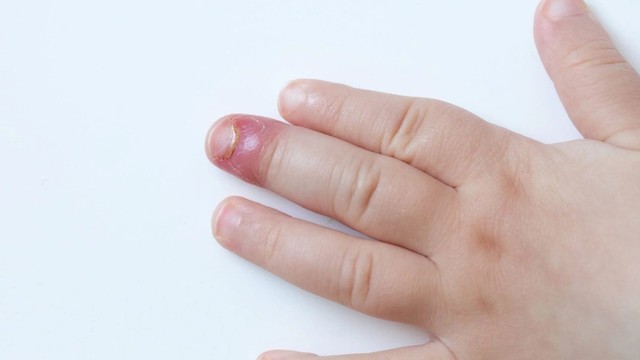 bai-viet/cac-chin-me-thuong-gap-la-gi-cach-chua-tri-va-phong-benh-chin-me.html