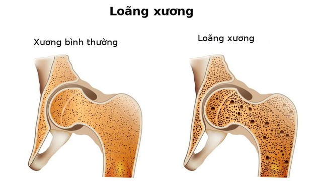 bai-viet/cac-dau-hieu-loang-xuong-nang-can-biet-60231.html