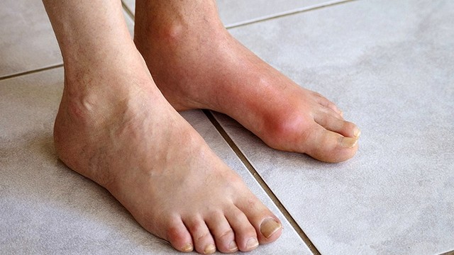 bai-viet/cac-giai-doan-cua-benh-gout-va-dau-hieu-nhan-biet.html