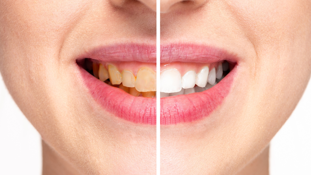 bai-viet/tong-hop-14-cach-tay-trang-rang-o-vang-khoa-hoc-tai-nha.html