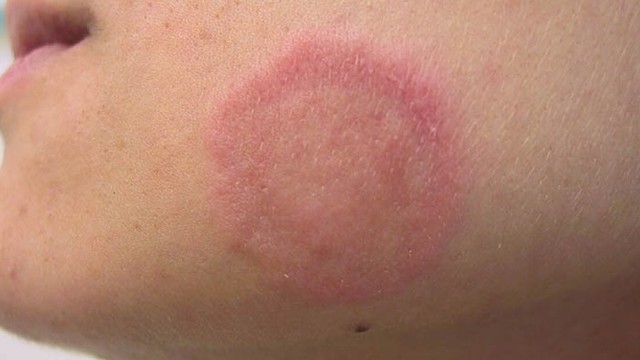 bai-viet/cac-loai-thuoc-tri-hac-lao-o-mat-hieu-qua-55458.html