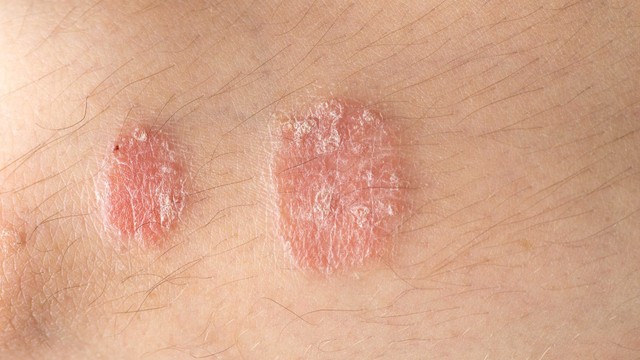 bai-viet/cac-loai-thuoc-tri-vay-nen-cua-my-pho-bien-va-luu-y-khi-su-dung-thuoc.html