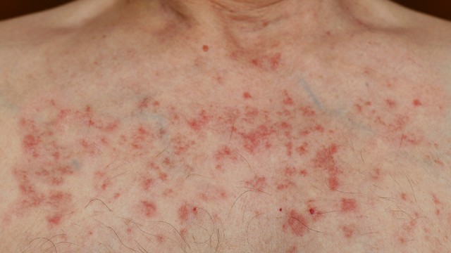 bai-viet/cac-phan-ung-cua-da-khi-ap-dung-lieu-phap-nham-dich-va-lieu-phap-mien-dich-trong-dieu-tri-ung-thu-54300.html