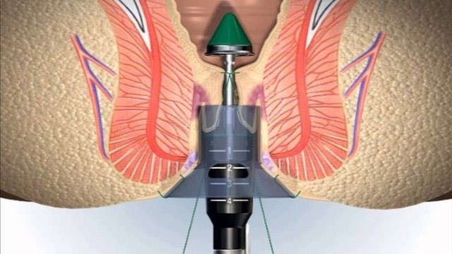 bai-viet/cac-phuong-phap-cat-tri-trong-y-khoa-hien-nay.html