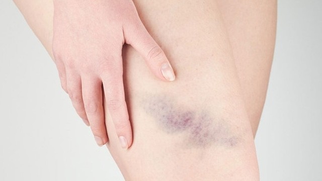 bai-viet/cac-phuong-phap-lam-tan-mau-bam-hieu-qua-tai-nha-68876.html