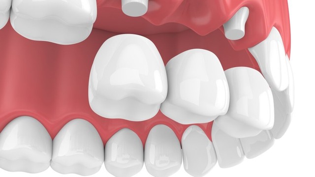 bai-viet/cac-phuong-phap-trong-rang-hieu-qua-nhat-hien-nay.html