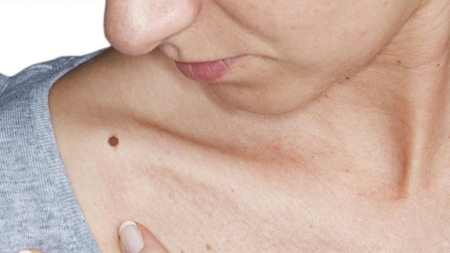 bai-viet/cac-phuong-phap-xoa-not-ruoi-60829.html