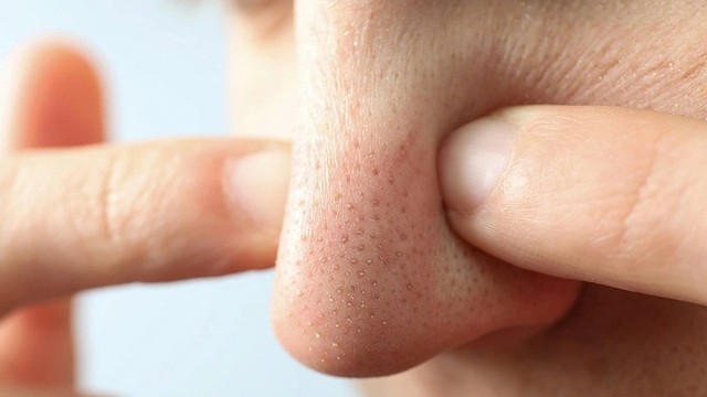 bai-viet/cac-san-pham-tri-mun-dau-den-o-mui-hieu-qua.html