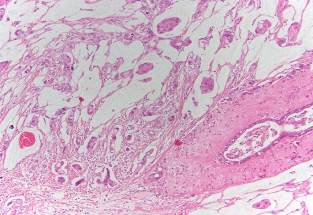 bai-viet/cac-thuat-ngu-trong-bao-cao-giai-phau-benh-pho-bien-ve-ung-thu-vu-53918.html