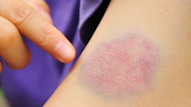 bai-viet/cac-loai-thuoc-tan-mau-bam-hieu-qua-hien-nay-la-gi-luu-y-khi-su-dung-thuoc-67075.html