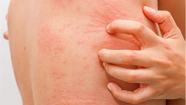 bai-viet/cac-trieu-chung-cua-zona-than-kinh.html