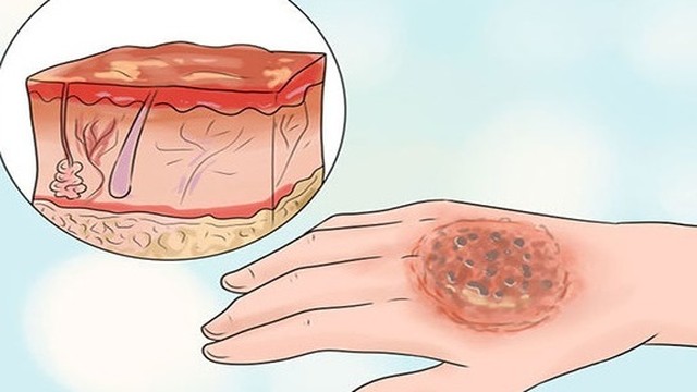 bai-viet/cach-cham-soc-vet-bong-bi-vo-tranh-nhiem-trung-phong-ngua-seo-62351.html